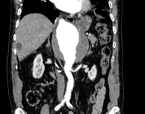 Abdominal aortic aneurysm (Radiopaedia 67117-76452 Coronal C+ arterial phase 49).jpg