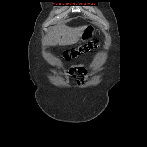 Abdominal aortic aneurysm (Radiopaedia 8190-9038 Coronal C+ arterial phase 15).jpg