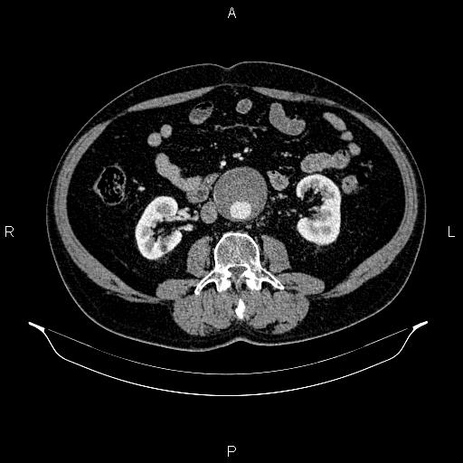 Abdominal aortic aneurysm (Radiopaedia 83094-97462 Axial renal cortical phase 101).jpg