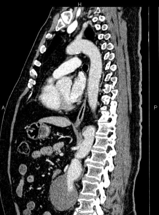 Abdominal aortic aneurysm (Radiopaedia 83094-97462 Sagittal renal cortical phase 70).jpg