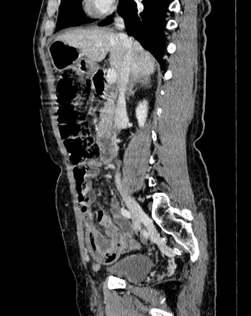 Abdominal aortic aneurysm (Radiopaedia 83581-98689 Sagittal C+ portal venous phase 23).jpg