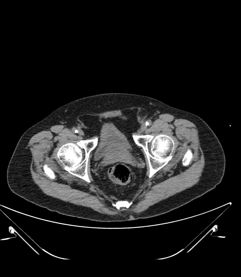 Abdominal aortic aneurysm with thrombus fissuration (Radiopaedia 46218-50618 Axial non-contrast 55).jpg