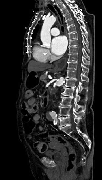 Abdominal aortic aneurysm with thrombus fissuration (Radiopaedia 73192-83919 Sagittal C+ arterial phase 66).jpg