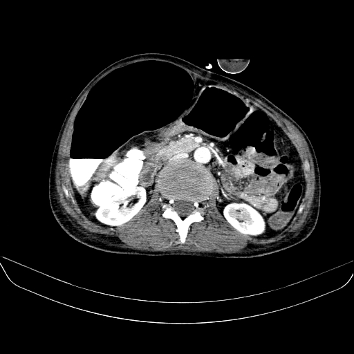 File:Abdominal collection due to previous cecal perforation (Radiopaedia 80831-94320 Axial C+ portal venous phase 89).jpg