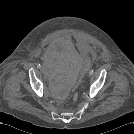 Abdominal hematoma (Radiopaedia 33614-34715 Axial C+ portal venous phase 112).png