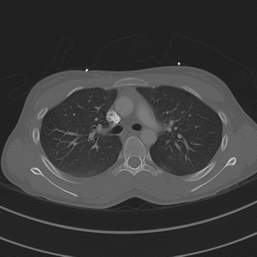 File:Abdominal multi-trauma - devascularised kidney and liver, spleen and pancreatic lacerations (Radiopaedia 34984-36486 I 32).png