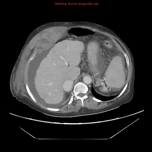 File:Abdominal wall hematoma (Radiopaedia 9427-10112 Axial C+ portal venous phase 27).jpg