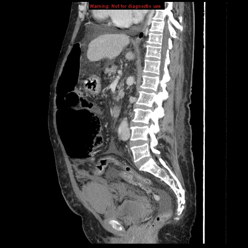 Abdominal wall hematoma (Radiopaedia 9427-10112 Sagittal C+ portal venous phase 54).jpg