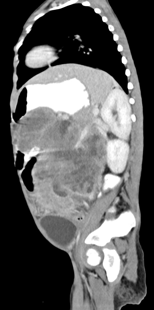 Abdominopelvic rhabdomyosarcoma (Radiopaedia 78356-90984 Sagittal C+ portal venous phase 31).jpg
