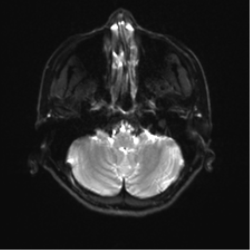 File:Abducens nerve palsy (Radiopaedia 51069-56648 Axial DWI 4).png