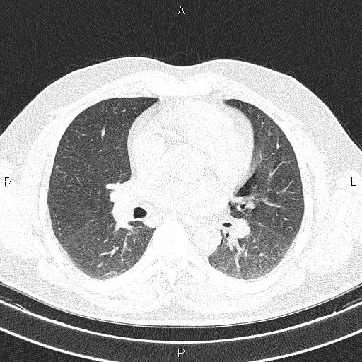 Aberrant right subclavian artery (Radiopaedia 87093-103354 Axial lung window 57).jpg