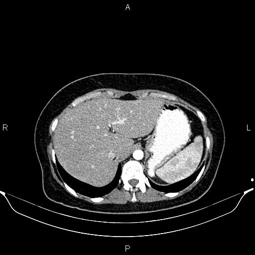 Aberrant right subclavian artery (Radiopaedia 87334-103629 Axial C+ arterial phase 61).jpg