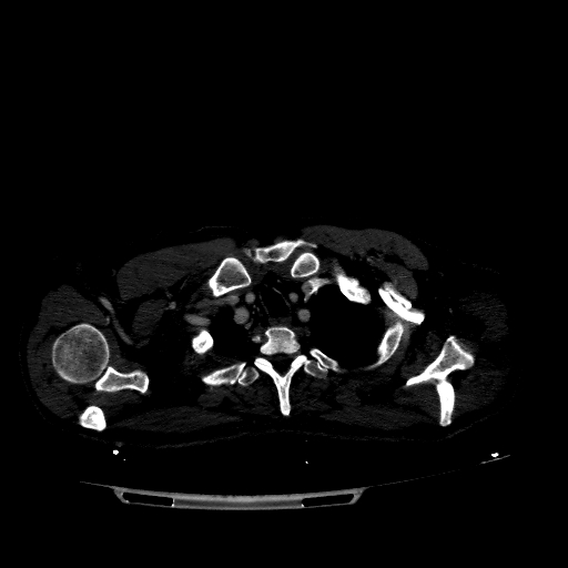 Accesory rib joint (Radiopaedia 71987-82452 Axial bone window 88).jpg