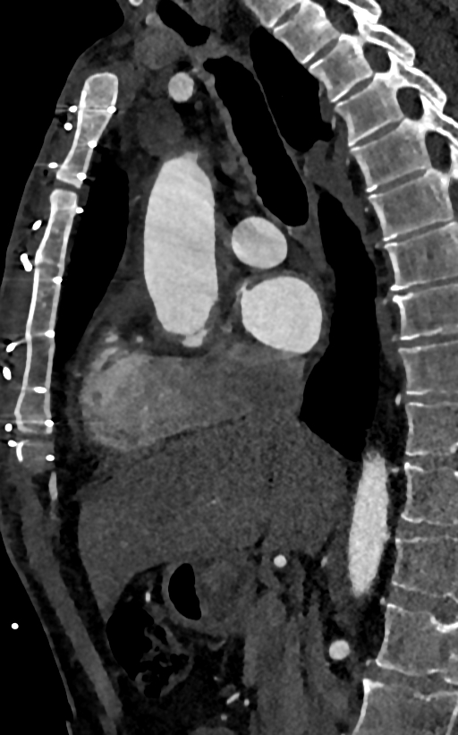 Accessory left atrial appendage (Radiopaedia 81987-95968 Sagittal C+ arterial phase 39).jpg