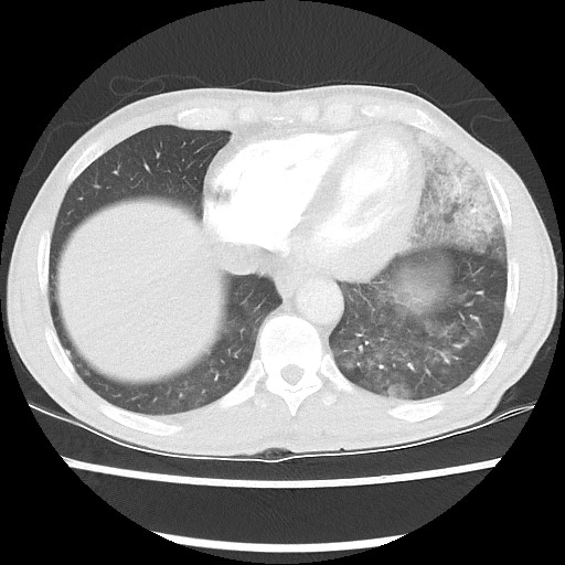 Accessory left horizontal fissure with lingular pneumonia (Radiopaedia 53763-59843 Axial lung window 43).jpg