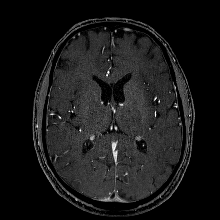 Accessory middle cerebral artery (Radiopaedia 73114-83828 Axial MRA 116).jpg