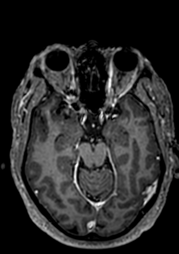 File:Accessory middle cerebral artery (Radiopaedia 73114-83828 Axial T1 C+ 83).jpg