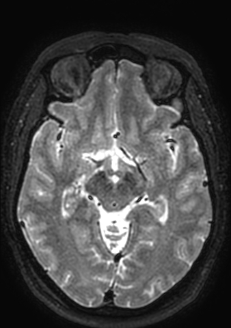 File:Accessory middle cerebral artery (Radiopaedia 73114-83828 Axial T2 100).jpg