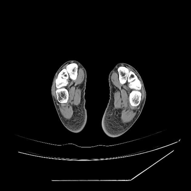 Accessory soleus muscle (Radiopaedia 61069-68943 Axial non-contrast 78).jpg