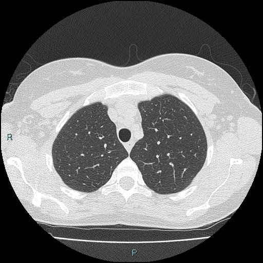 File:Accidental foreign body aspiration (seamstress needle) (Radiopaedia 77740-89983 Axial lung window 15).jpg