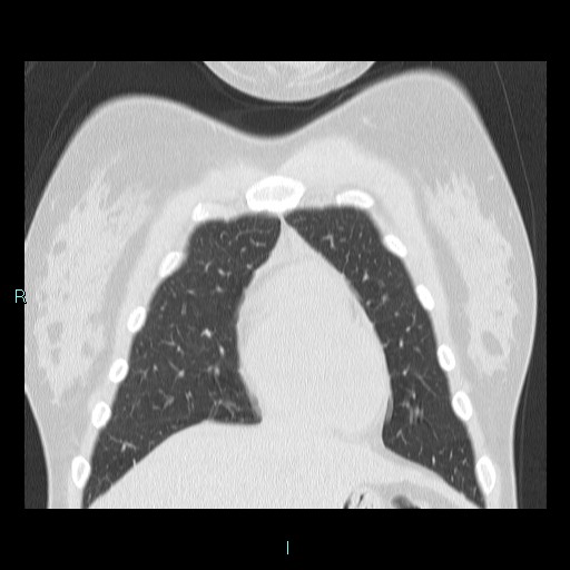 Accidental foreign body aspiration (seamstress needle) (Radiopaedia 77740-89983 Coronal lung window 52).jpg
