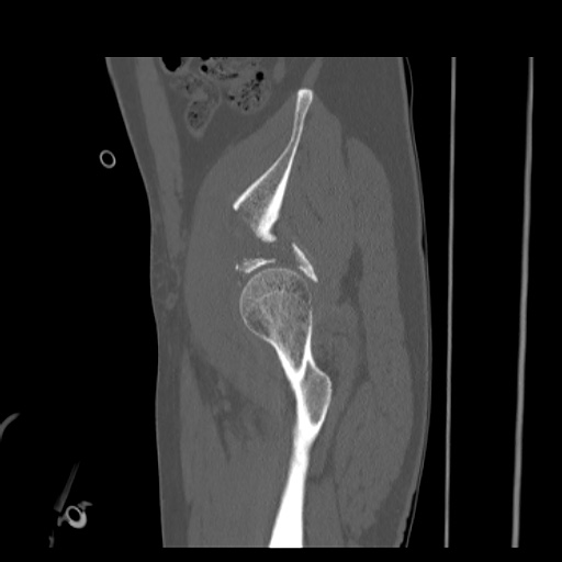 File:Acetabular and ilial fractures (Radiopaedia 59084-66378 Sagittal bone window 20).jpg