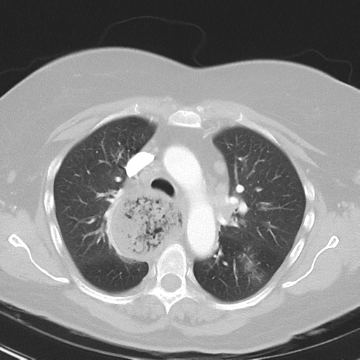 Achalasia (Radiopaedia 47147-51685 Axial lung window 18).png