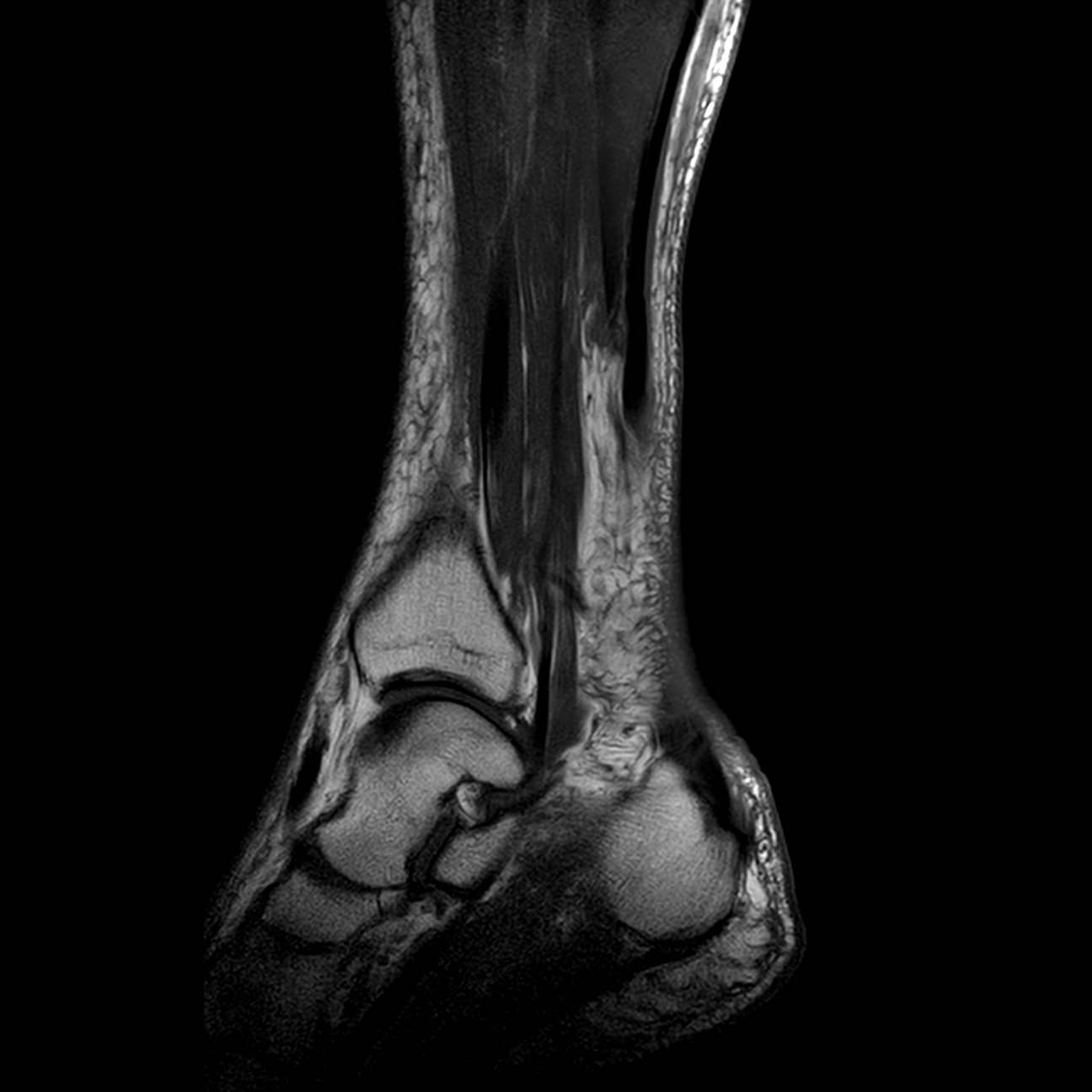 File:Achilles tendon rupture, complete (Radiopaedia 61601-69580 ...
