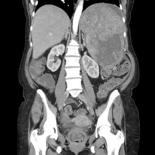 Acinar cell carcinoma of the pancreas (Radiopaedia 75442-86669 Coronal C+ portal venous phase 77).jpg