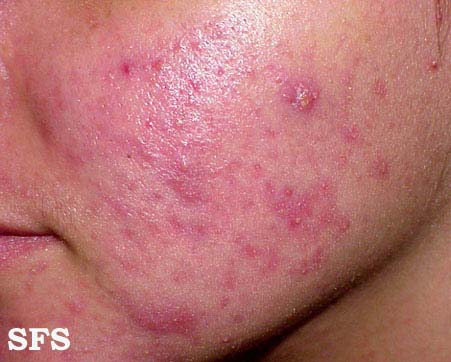 Acne Rosacea (Dermatology Atlas 6).jpg