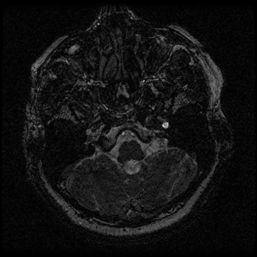 Acoustic schwannoma (Radiopaedia 33045-34060 Axial T2 5).png