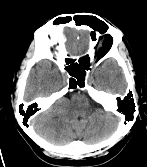 File:Acoustic schwannoma (Radiopaedia 33045-34065 Axial non-contrast 6).png