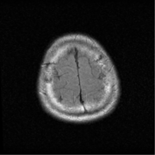 File:Acoustic schwannoma (Radiopaedia 39170-41387 Axial FLAIR 20).png