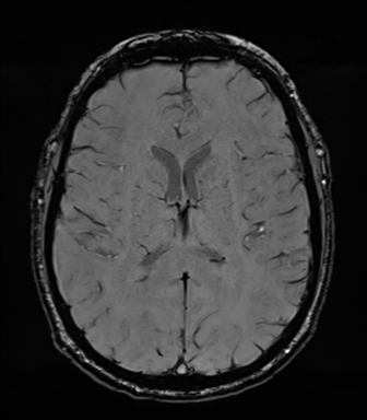 Acoustic schwannoma (Radiopaedia 50846-56358 Axial SWI 55).png