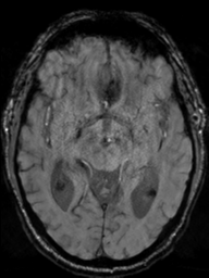 Acoustic schwannoma (Radiopaedia 55729-62281 Axial SWI 23).png