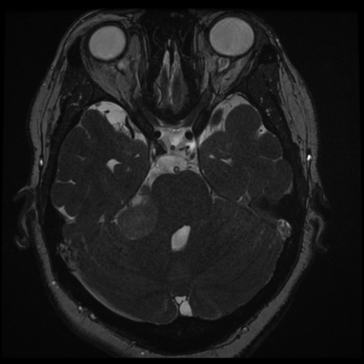 Acoustic schwannoma (Radiopaedia 57574-64536 Axial T2 59).png