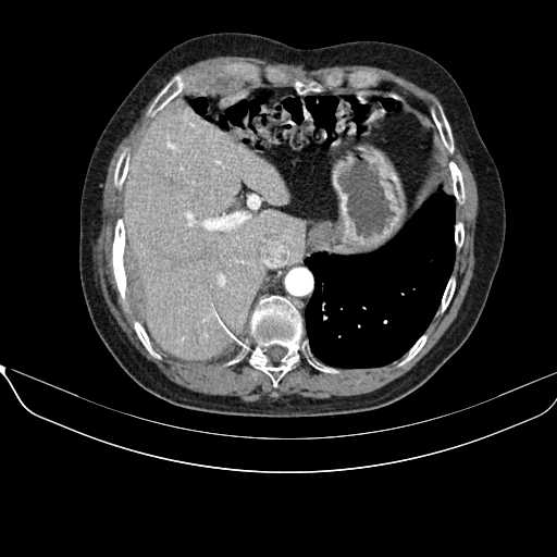 File:Acquired adrenal hyperplasia - due to thymic carcinoid tumor (Radiopaedia 21269-21184 C+ arterial phase 10).jpg