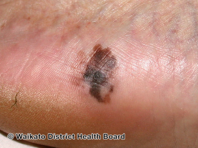 File:Acral lentiginous melanoma (DermNet NZ melanoma-143).jpg