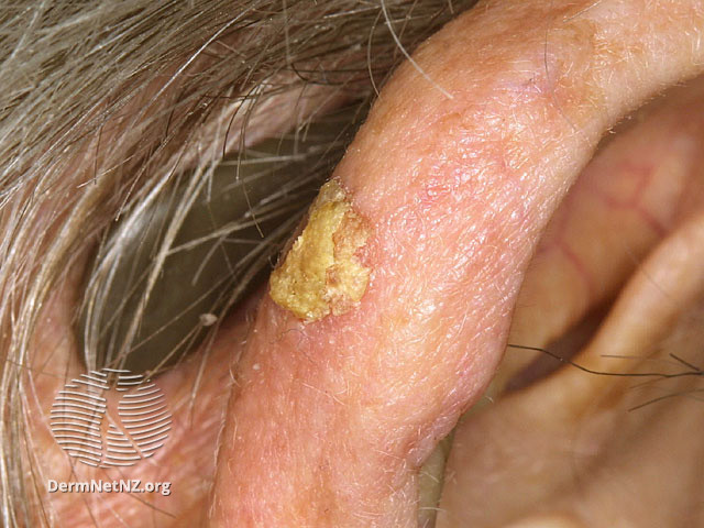 File:Actinic keratoses (DermNet NZ lesions-s-sk4).jpg