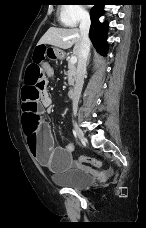 Active Crohn disease (Radiopaedia 59394-66750 Sagittal C+ portal venous phase 33).jpg