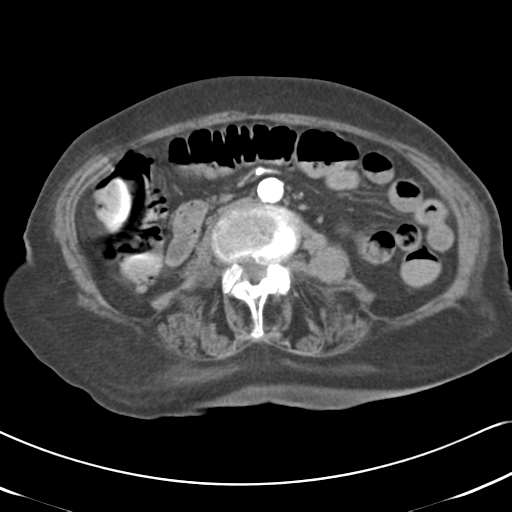 File:Active bleeding from duodenal ulcer with embolization (Radiopaedia 34216-35481 Axial C+ arterial phase 31).png