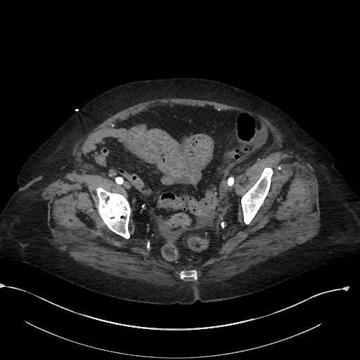 Active renal extravasation with large subcapsular and retroperitoneal hemorrhage (Radiopaedia 60975-68796 Axial C+ arterial phase 169).jpg