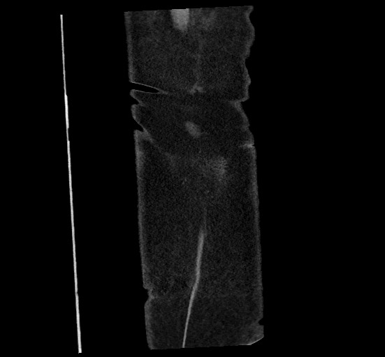 Active renal extravasation with large subcapsular and retroperitoneal hemorrhage (Radiopaedia 60975-68796 Coronal C+ portal venous phase 149).jpg