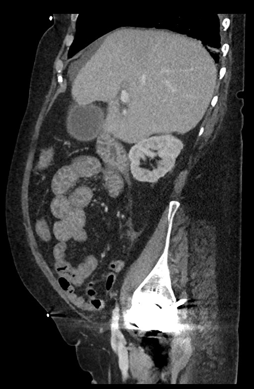 Active renal extravasation with large subcapsular and retroperitoneal hemorrhage (Radiopaedia 60975-68796 Sagittal C+ portal venous phase 156).jpg
