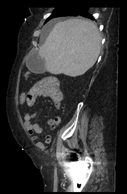 Active renal extravasation with large subcapsular and retroperitoneal hemorrhage (Radiopaedia 60975-68796 Sagittal C+ portal venous phase 169).jpg