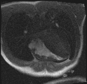 File:Active right ventricular cardiac sarcoidosis (Radiopaedia 55596-62100 Axial Dynamic perfusion scan MOCO 34).jpg