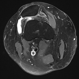 File:Acute-on-chronic transient lateral patellar dislocation with trochlear dysplasia (Radiopaedia 84099-99349 Axial PD fat sat 8).jpg