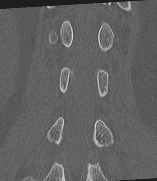 File:Acute L1 burst compression fracture (Radiopaedia 34430-35755 Coronal bone window 38).png