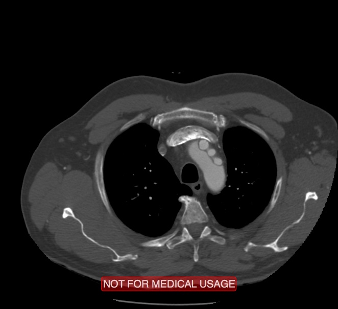 Acute aortic dissection - Stanford type A (Radiopaedia 40661-43285 Axial C+ arterial phase 1).jpg