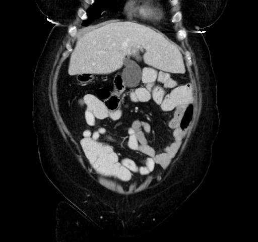 Acute appendicitis, heterotaxy syndrome (Radiopaedia 66884-76202 Coronal C+ portal venous phase 30).jpg
